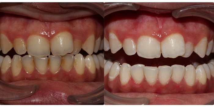 teeth cleaning before and after